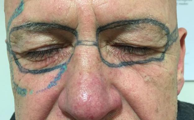 Se tatúa unas gafas en una despedida de soltero y tarda dos años en eliminarlas