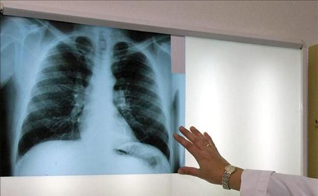La Seguridad Social reconoce que el amianto es el causante del cáncer de dos extrabajadores guipuzcoanos